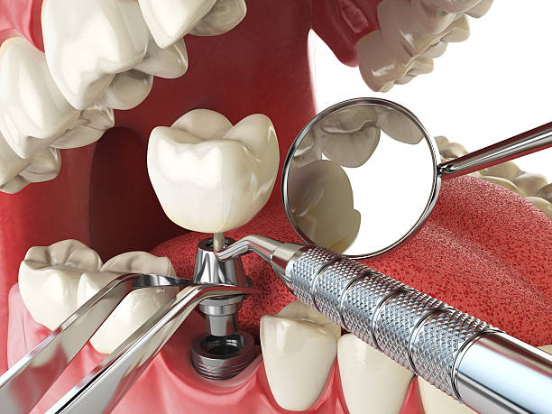Best Emergency Dentist for Lost Fillings or Crowns in Laredo, TX